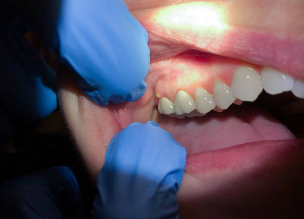 Best Teeth Whitening  in Fayette, OH