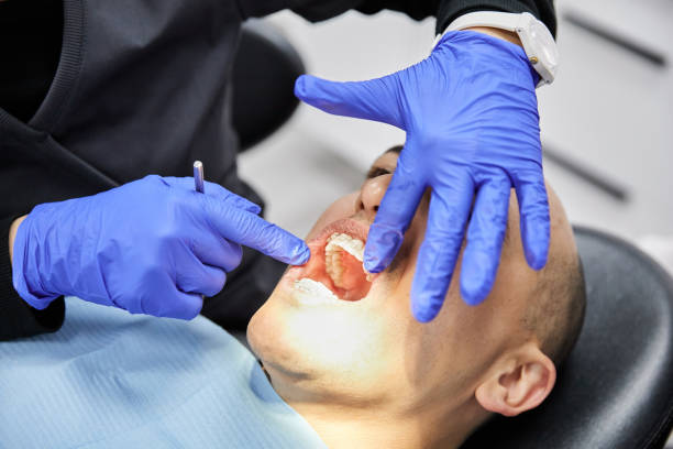 Best Chipped Tooth Repair Near Me  in Fayette, OH